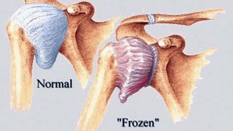 Physiotherapy plus Steroid injection has better outcome in frozen shoulder