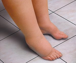 Ketoprofen found effective for treating lymphedema symptoms