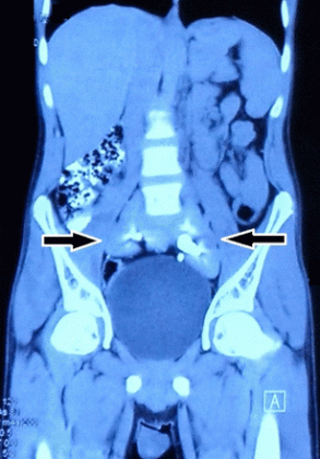 Delhi doctors report a rare case of Pancake Kidney