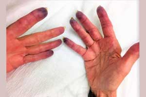 Case of female presenting with purple fingertips