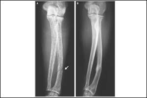 Parathyroid carcinoma presenting as radial fracture