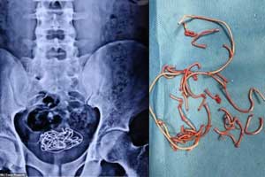 KGMC Doctors remove knotted electric wire from bladder of teenager