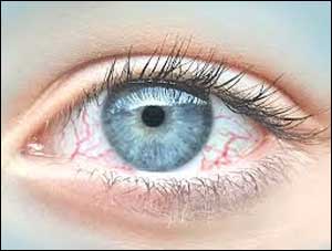 Poor air quality may worsen dry eye disease conditions