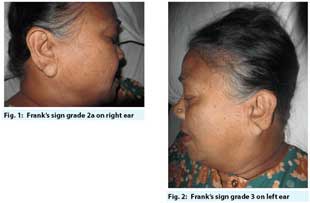 Frank’s Sign in a patient of Diabetes and hypertension