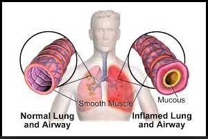 A Paradox - Case of asthma worsening with asthma drugs