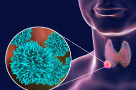 Low risk thyroid cancer patients can receive lower doses of radiation