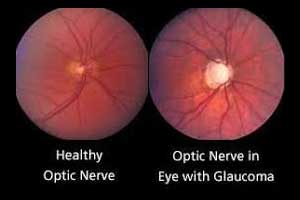 Traditional glaucoma test can miss severity of disease
