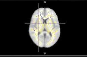 MRI a better tool to predict Alzheimers disease