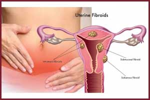 Elagolix reduces menstrual bleeding in women with Fibroids