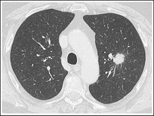 Case of Erythroderma and a Pulmonary Nodule reported by NEJM