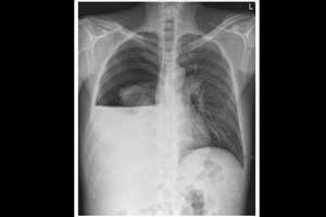 Hydropneumothorax in man with history of alcohol abuse associated cirrhosis