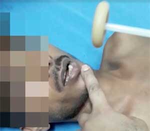 Safdarjung Hospital doctors report classical case of Jaw clonus and limb fasciculations