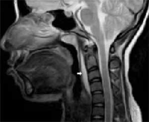 Rare case of Lemierre’s syndrome in pregnancy