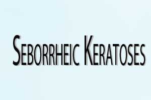 Topical Hydrogen Peroxide May Be Most Effective for Facial Seborrheic Keratoses