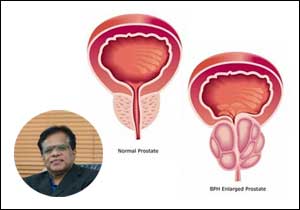 Urinary obstruction: A disease of elderly men