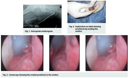 Case study of a unique cause of Acute Urinary Retention