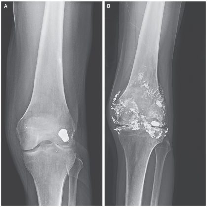 Case of Knee Arthritis due to embedded bullet for over decade