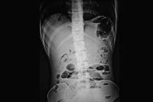 Case of isolated omental panniculitis presenting as intestinal obstruction