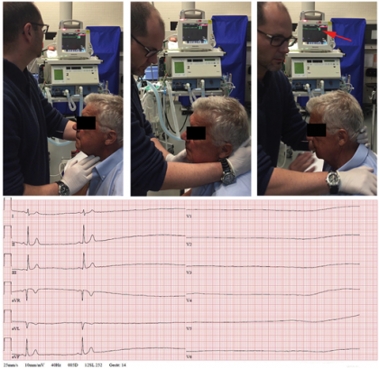 Cardiac arrest while diving due to Carotid sinus syndrome