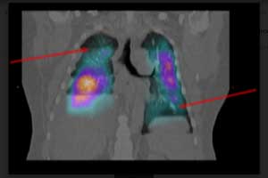 Antiphospholipid syndrome in man with severe pulmonary hypertension