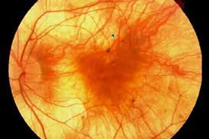 Gene therapy may improve visual acuity in choroideremia : Phase 2 study
