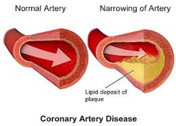 Beta-blockers have no survival benefit beyond 1 year in Post MI  stable CAD