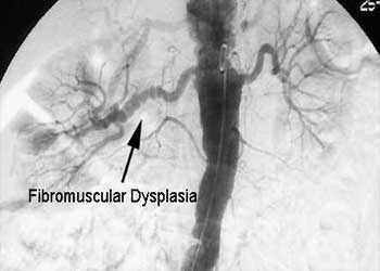 Management of fibromuscular dysplasia: First international Guideline