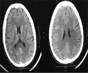 An unusual case of lacunar stroke with oral contraceptives