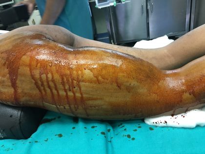 Sir Ganga Ram Hospital doctors remove largest tumour from thigh, save leg