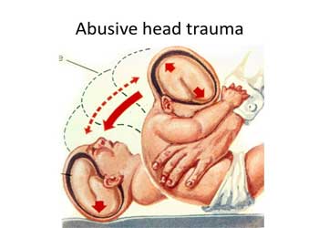 retinal hemorrhage shaken baby