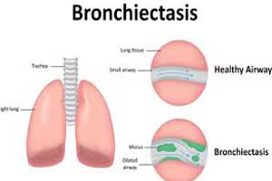 Vitamin D a good predictor of clinical severity of bronchiectasis