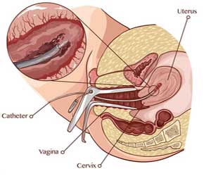 Endometrial Scratching of no benefit for women undergoing IVF: NEJM
