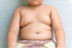 Higher belly fat in children linked to osteoporosis