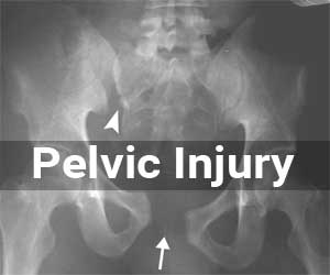 Early management of severe pelvic injury: French Guidelines