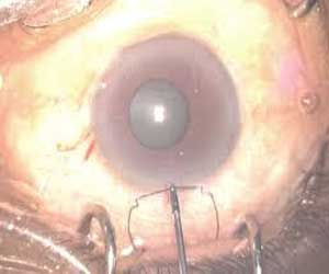 Pupil expansion rings versus iris hooks: cataract surgery in small pupil