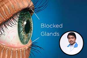 Dry Eyes?? Do not ignore, it could be a sign of thyroid disorder and meibomian gland dysfunction