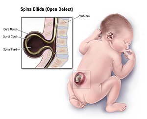“Keyhole” Surgery Repairs Spina Bifida In Utero