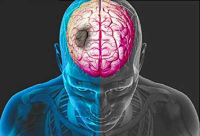 Post stroke rehabilitation care- US guidelines