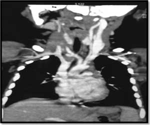 AIIMS doctors report rare case of cervical congenital infantile fibrosarcoma