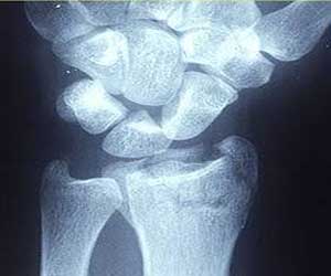 To Plate or to Cast in distal radius fracture in elderly ?