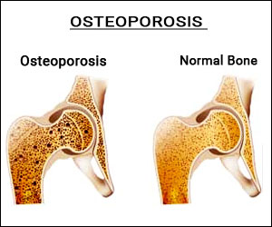 Family history of diabetes decreases chances of osteoporosis in postmenopausal women, finds study