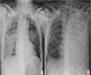 Doctors save patient of bilateral traumatic wet lung after thoracic trauma