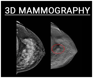 3D mammography brings down breast biopsy rates significantly