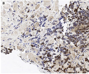 Rare Case Of Cardiac Metastasis Of Malignant Melanoma