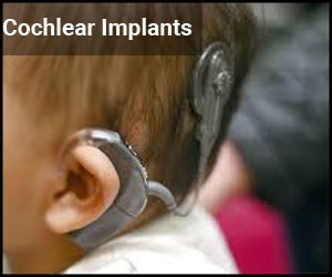 Cochlear Implantation before 12 months may empower kids to speak, understand language