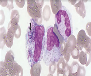 A case of disseminated histoplasmosis in patient with HIV infection: NEJM