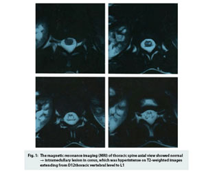 Rare Case of Epstein-Barr virus myelitis in immunocompetent individual: JAPI