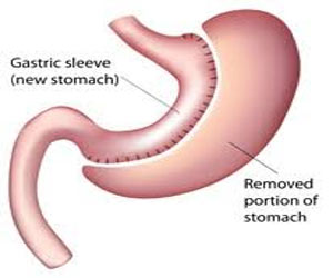 Sleeve gastrectomy safer than Gastric bypass for patients of Crohn's ...