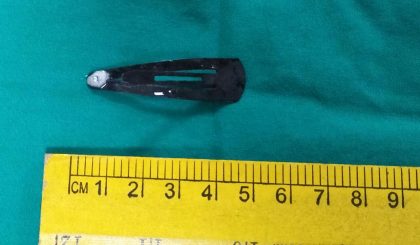 1.5 Yr Old Boy Swallowed 4cm Tic Tac Hair Pin, Removed at Wadia Hospital
