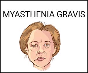 Hypophonia as only presenting symptom in myasthenia gravis: a case report